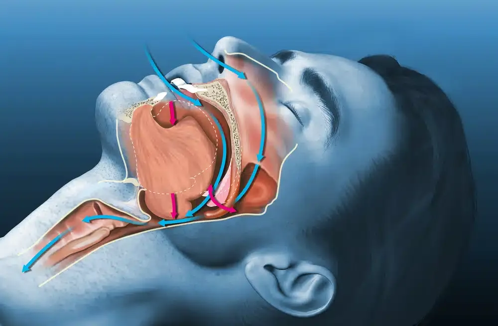 Cochlear Implantation Program