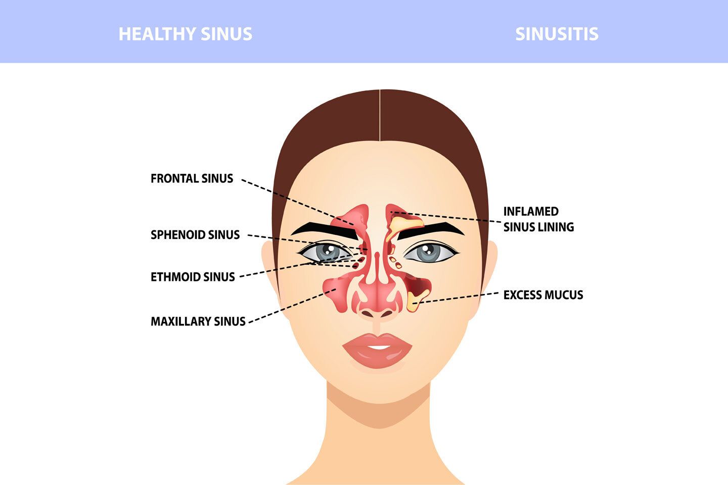 Allergic Rhinitis and Rhinosinusitis